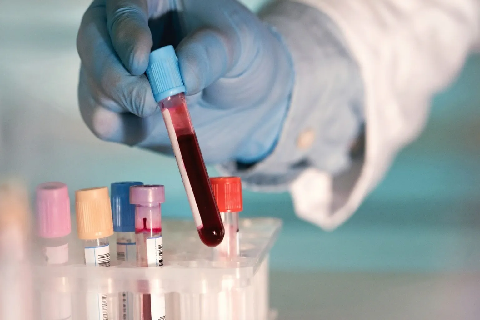 The Critical Pathologist Shortage Threatening Cancer Care and Precision Medicine